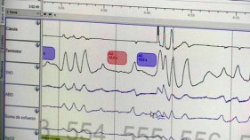 L'Hospital de Palamós amplia la unitat del son per tractar pacients també des del centre