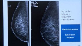 L'Hospital de Palamós millora la detecció del càncer de mama gràcies a l'Oncotrail