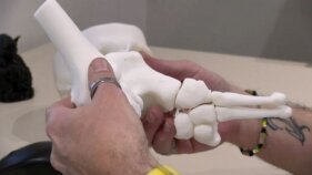 L'Hospital de Palamós utilitza les reproduccions en 3D per planificar cirurgies complexes